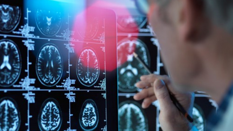  Primul caz de Alzheimer la un pacient de 19 ani. Tânărul a prezentat simptome de la 17 ani și a fost nevoit să renunţe la şcoală