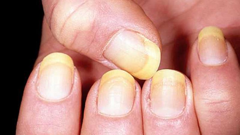 dezvoltarea ciupercii unghiilor pe mâini